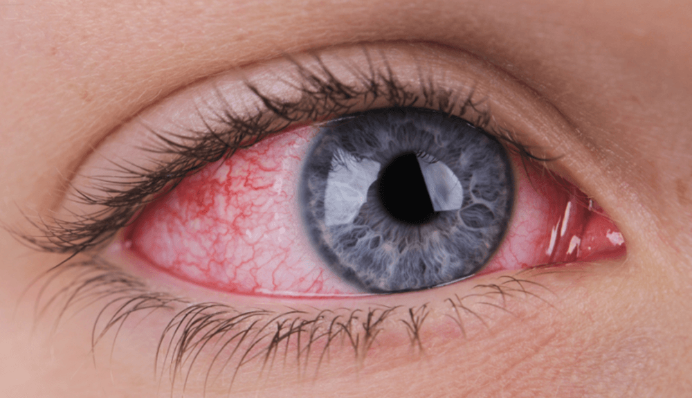 Close-up photo of a person's eyes with a red, irritated appearance, likely caused by sunburn (photokeratitis)
